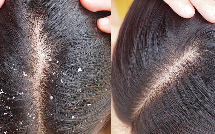 Henna Hair Mask For Dandruff And GREY Hair